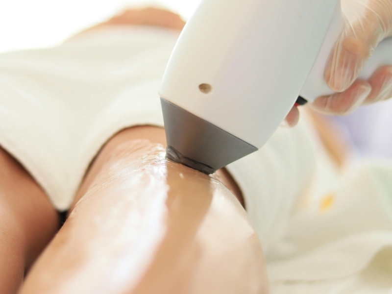 Epilazione Laser Definitiva!